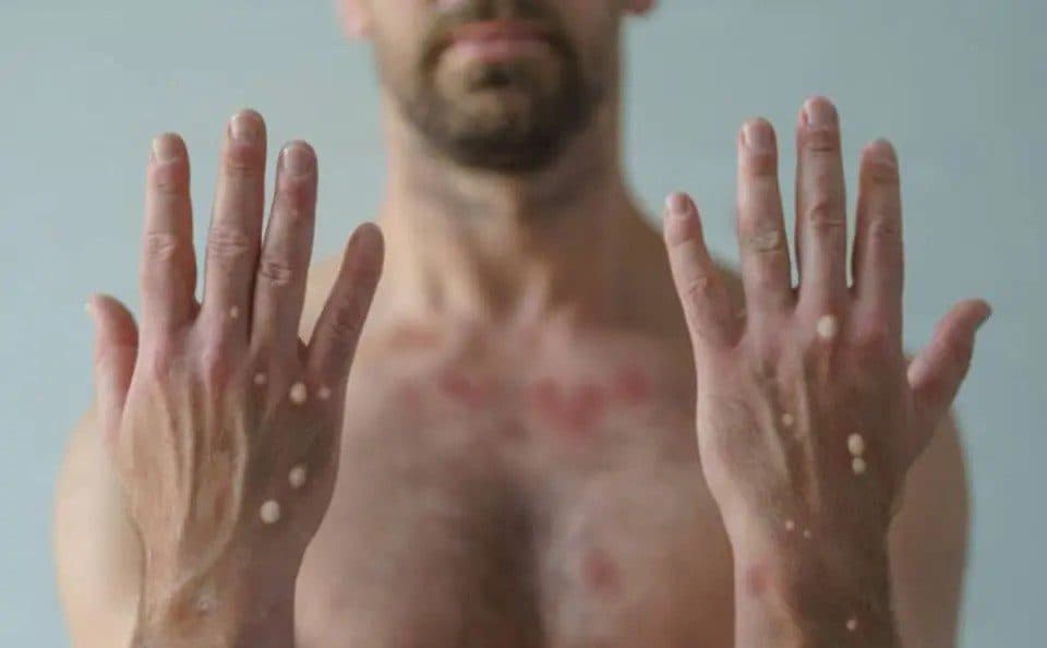 Rio Grande do Norte investiga caso suspeito de mpox em jovem que esteve em João Pessoa