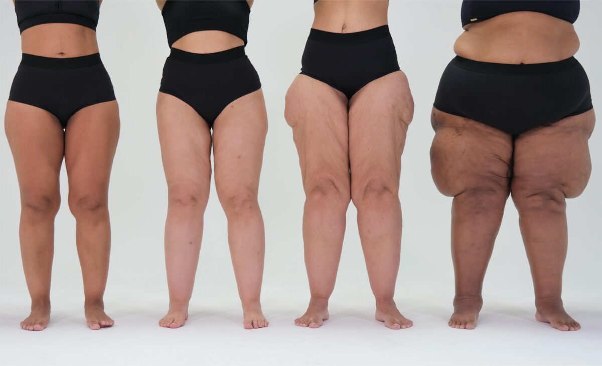 Mulheres com níveis diferentes de lipedema